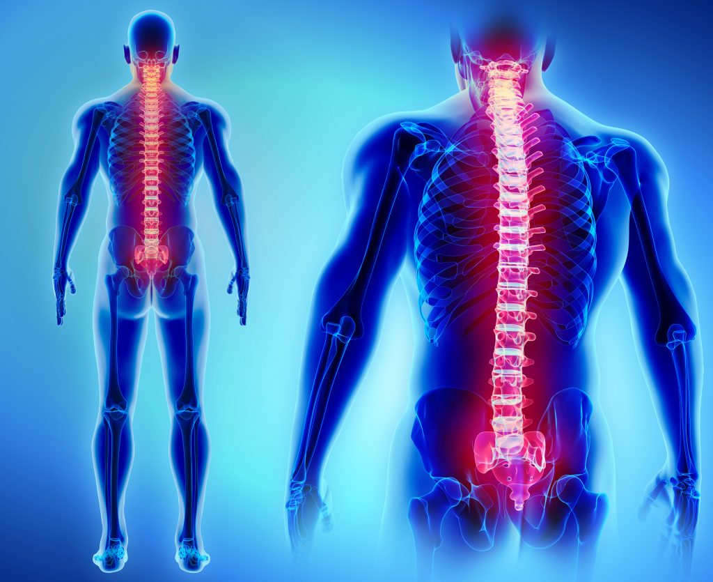 florida spinal cord injury lawsuit claim attorney